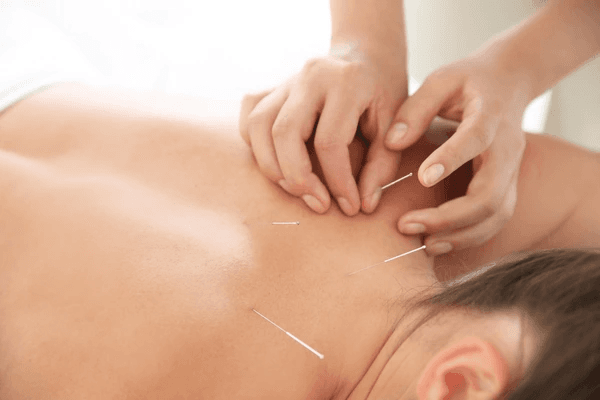 Acupuncture treatment being applied to a patient’s upper back